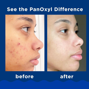 PanOxyl Acne Foaming Wash Benzoyl Peroxide 10% aknega qarshi yuz yuvish ko'pigi (10% benzoyl peroksid bilan)