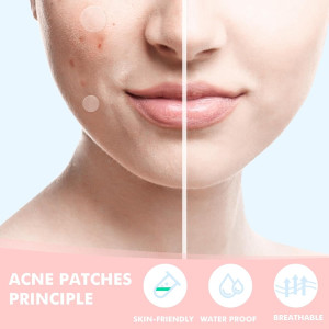 Пластыри от прыщей Pimple Patches for Face - 304штук
