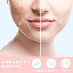 Pimple Patches for Face husnbuzarlarga qarshi plastirlar - 304 dona