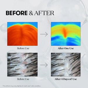 VT PDRN Reedle Shot Hair Ampoule 100dl - 15 ml bosh terisi va soch o'sish chizig'ini mustahkamlash uchun ampulali parvarish