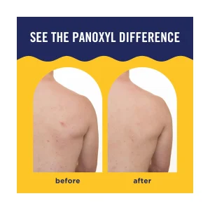 Спрей для тела против несовершенств PanOxyl Acne Banishing Body Spray 2% Salicylic Acid, 170 г