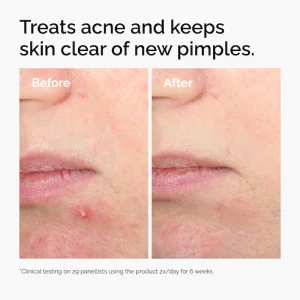 The Ordinary Salicylic Acid 2% Solution, Exfoliating Serum for Acne - 30 ml aknega qarshi eksfoliatsiya qiluvchi sivorotka