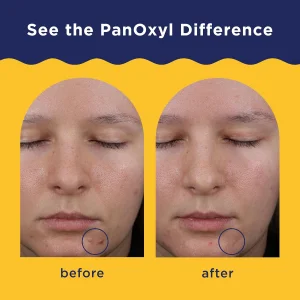 Маска для сужения пор и борьбы с акне для лица PanOxyl Pore Refining Acne Mask, 5% Colloidal Sulfur - 85 g