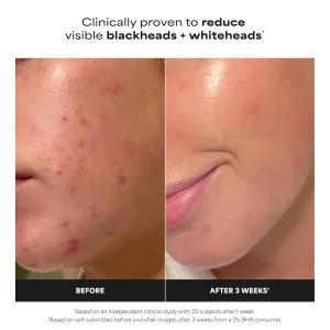 Отшелушивающий тоник для лица Paula's Choice  Skin Perfecting 2% BHA Exfoliating Toner for Clear Skin - 118 ml